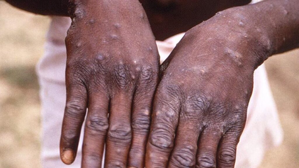 Maymun çiçeği: Türkiye’yi bekleyen tehlike