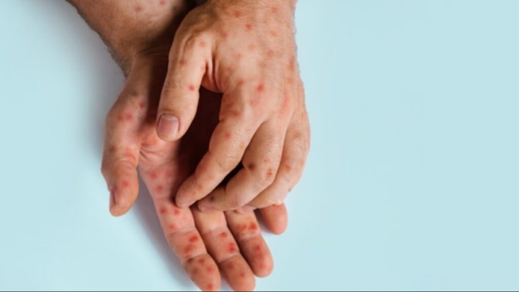 Mpox salgını hızla yayılıyor: Sınırlara ek kontrol geliyor