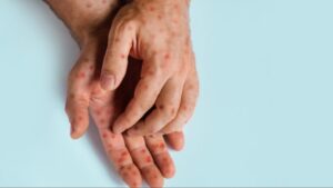 Mpox salgını hızla yayılıyor: Sınırlara ek kontrol geliyor