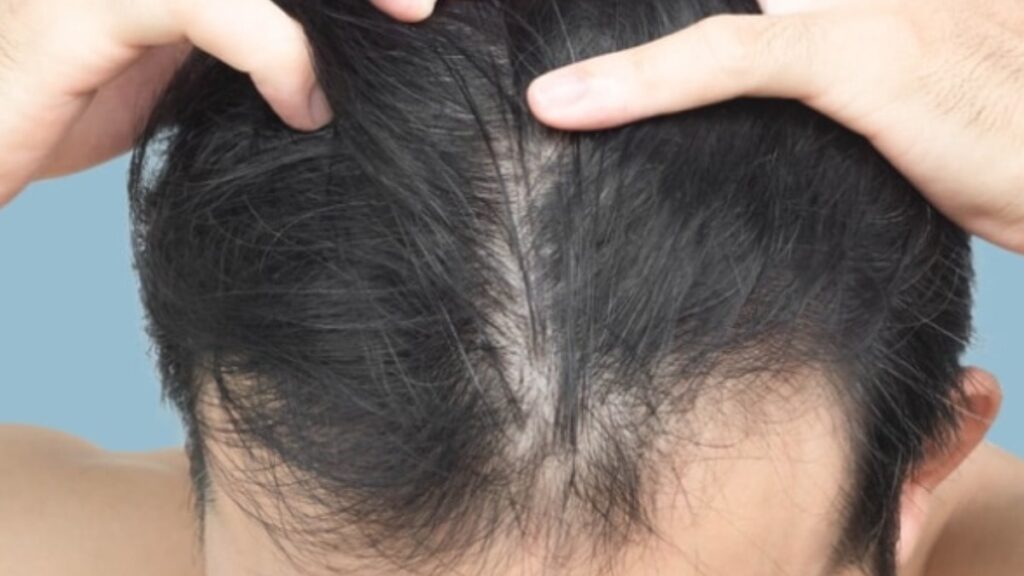 2 günden uzun süren kaşıntıya dikkat! Saç diplerini yaralarla dolduruyor