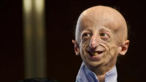 Hızlı yaşlanma hastalığıyla mücadele eden Sammy Basso, hayata veda etti