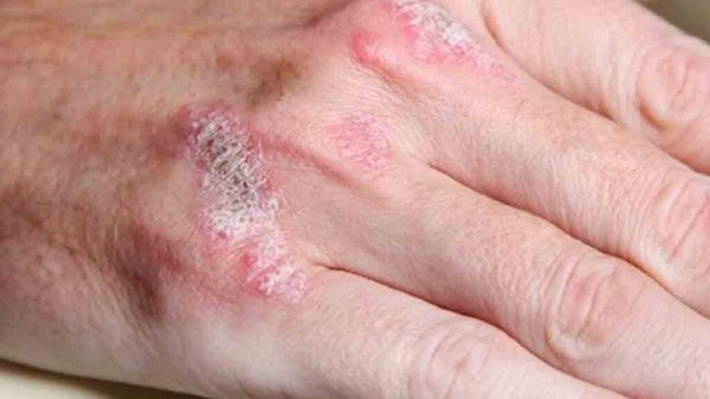 Bu yiyecekler doğrudan sedef hastalığıyla bağlantılı olabilir: Fransız dermatologlar araştırdı