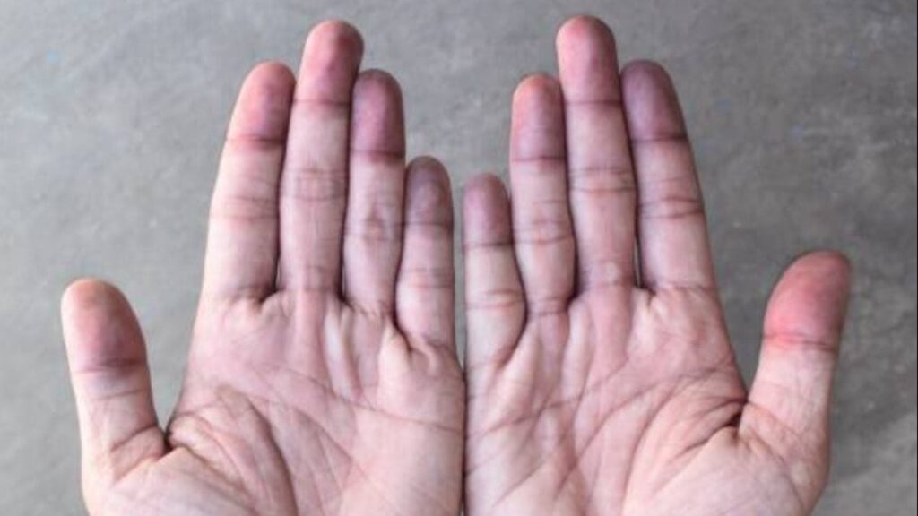 Ellerinize dikkat edin! Hastalıkların ilk belirtisi tırnaklarda görülüyor…