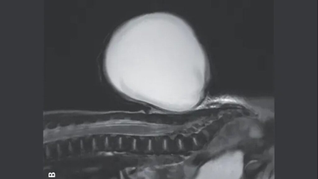 Bebeğin sırtında 7.7 santimetrelik ‘balon’ oluştu