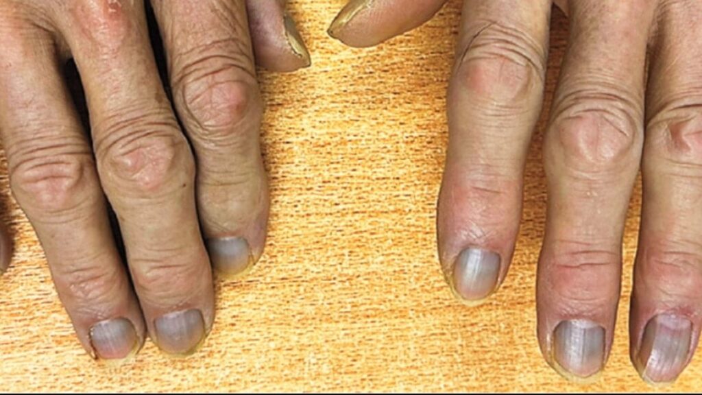 Doktorlar şaştı kaldı! Cildi, tırnakları ve gözleri griye döndü