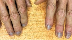 Doktorlar şaştı kaldı! Cildi, tırnakları ve gözleri griye döndü