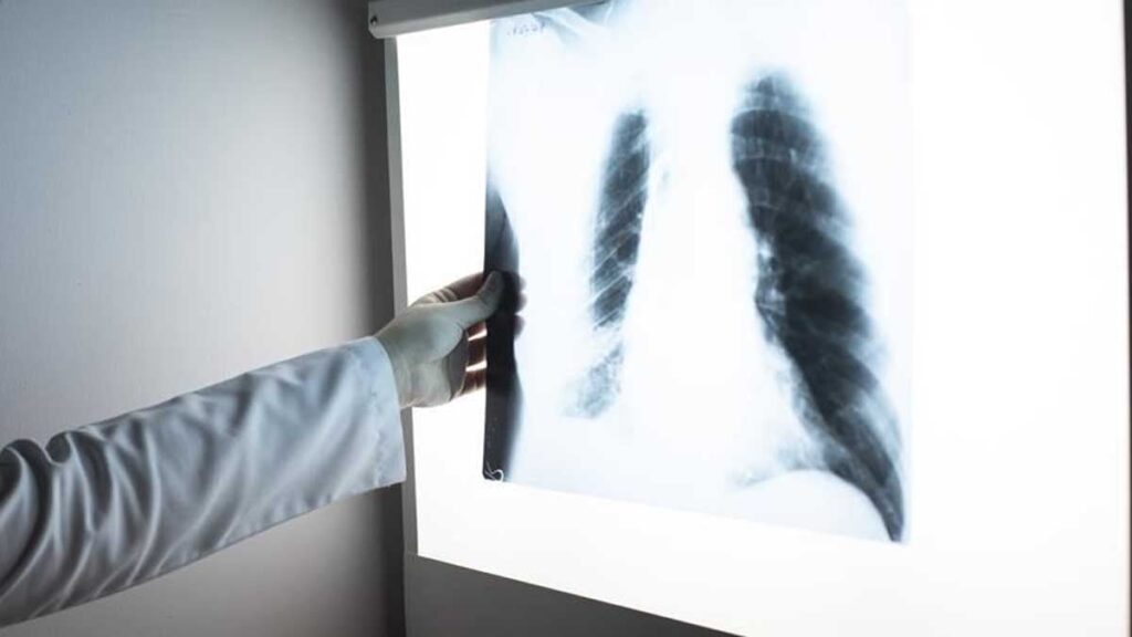 Sigara içmeyen kişilerde akciğer kanseri artıyor: Araştırmalar ortak bir nedene işaret ediyor