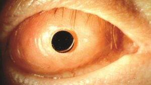 Gözlerini diş ile iyileştiriyorlar: Devrim gibi tedavi