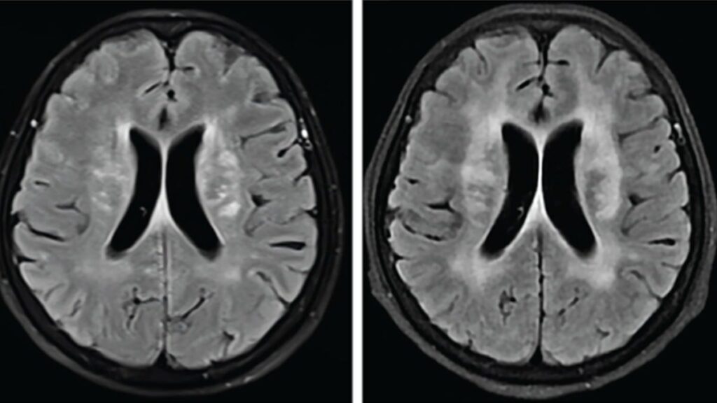Mutfaktaki basit bir hata sonucu beynini kurtlar sardı