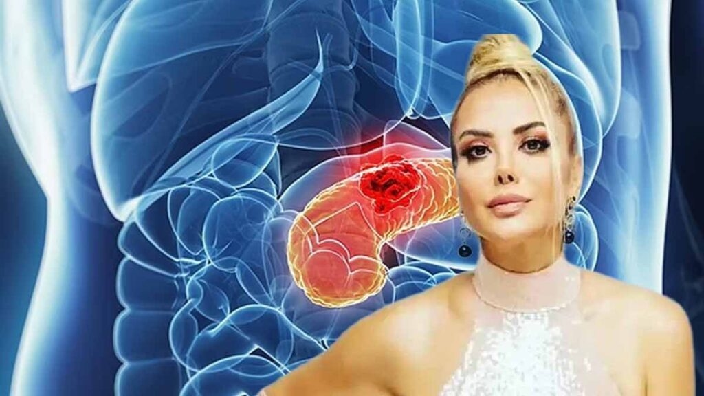Pankreas kanserinin belirtileri nelerdir, Tanyeli nasıl öğrendi? İşte 2. 3. 4. evre pankreas kanseri belirtileri