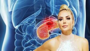 Pankreas kanserinin belirtileri nelerdir, Tanyeli nasıl öğrendi? İşte 2. 3. 4. evre pankreas kanseri belirtileri