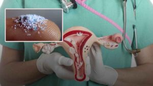 Kadınların yumurtalıklarından alınan sıvıda mililitre başına binlerce mikroplastik parçacığı bulundu