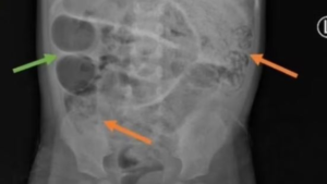 Karnı şişen 3 yaşındaki çocuk ağız dolusu kusunca gerçeği öğrendiler