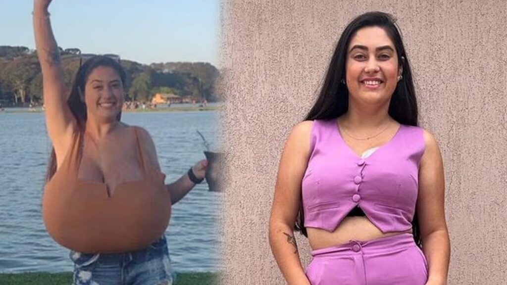 Sadece 300 kişide görülen hastalık: Göğüsleri aylar içinde 12 kiloya ulaştı