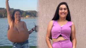 Sadece 300 kişide görülen hastalık: Göğüsleri aylar içinde 12 kiloya ulaştı