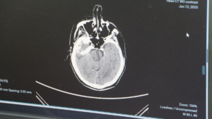 Gençlerde beyin kanaması görülme oranı giderek artıyor