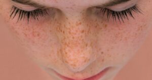 Yaz sonrası cilt lekesi artanlar dikkat