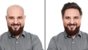 Kellik tedavisinde çığır açan çözüm: Saç büyümesini yüzde 539 artırıyor