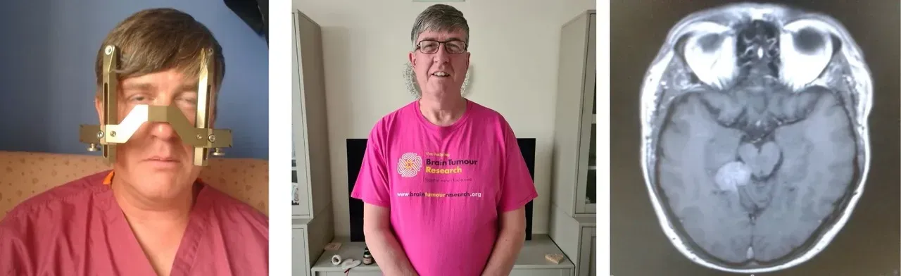 Kulak çınlamasını hafife aldı, gerçek MR’da ortaya çıktı: Ameliyat edilemeyen beyin tümörüyle karşı karşıya kaldı