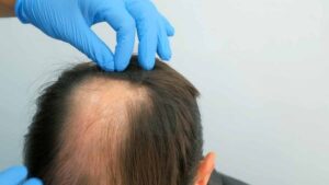 Stresin neden kelliğe yol açtığı belli oldu